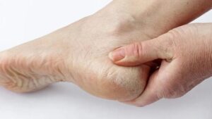 إزالة الجلد الميت بأبسط الطرق: سرّ الحصول على بشرة ناعمة ومتجددة