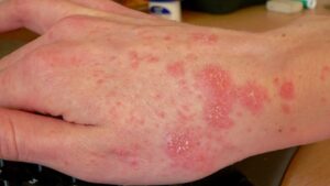 هل يعاني جسمك من نقص الفيتامينات؟ هذه أهم العلامات