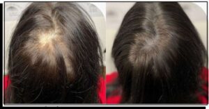 ماء البصل: السر الطبيعي لشعر كثيف وقوي 