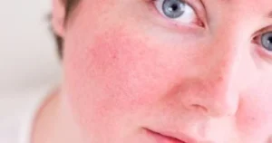 مفعول السحر في قطرة: كيف يرطّب الهيالورونيك أسيد بشرتك من الداخل