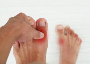 تعرف على النقرس: أسبابه وأهم نصائح الوقاية