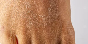 هل يعاني جسمك من نقص الفيتامينات؟ هذه أهم العلامات