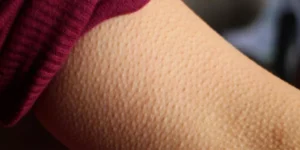 هل يزعجك جلد الدجاجة؟ الحلول السريعة والدائمة