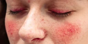 أعراض جفاف العين وأسرار الوقاية اليومية لصحة عينيك