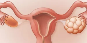 تكيس المبايض تحت السيطرة: أفضل العلاجات اليومية