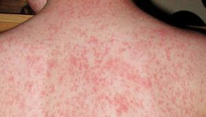 الحصبة: الطفح الخطير والحمى العالية.. ما يجب معرفته