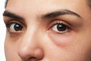 تورم تحت العين يُظهركِ متعبة؟ وصفات منزلية تخففه أياماً