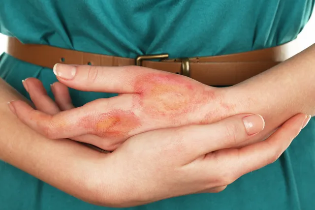 شفاء طبيعي للحروق: وصفات منزلية سحرية لإزالة الآثار والندبات