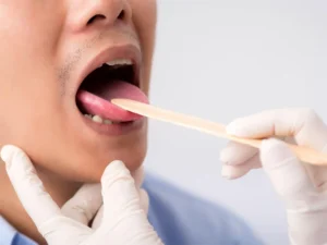 علاج التهاب اللوزتين بالأعشاب والوصفات المنزلية