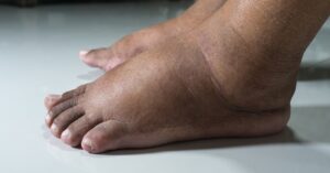 أفضل الأطعمة والأعشاب لطرد السوائل الزائدة من الجسم