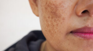 مفعول السحر في قطرة: كيف يرطّب الهيالورونيك أسيد بشرتك من الداخل