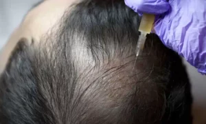 هل تُعتبر بلازما الشعر الحل النهائي لمشكلة الفراغات