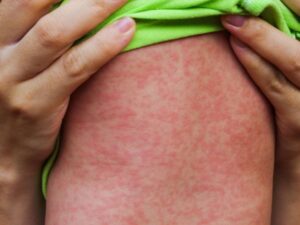 الحصبة: الطفح الخطير والحمى العالية.. ما يجب معرفته