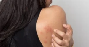 8 أطعمة ممنوعة لمرضى الحساسية تُشعل الجلد في ساعات – تجنبيها اليوم