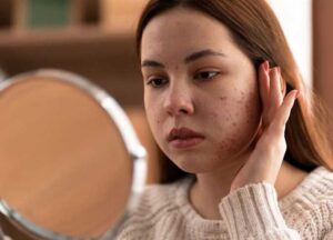 بشرة صافية في 14 يوم: نظام غذائي يطرد حب الشباب