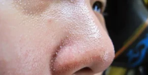 الحبوب البيضاء الصغيرة؟ 7 أسباب تُصيب 80% من النساء