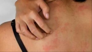 الطفح الجلدي المفاجئ يغطي وجهكِ أو جسمكِ فجأة؟ 8 أسباب تحسسية تُصيبك
