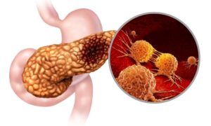 الكحول يدمّر دماغكِ في 6 أشهر: 7 أضرار تُصيب 90% من المدمنين