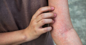 الطفح الجلدي المفاجئ يغطي وجهكِ أو جسمكِ فجأة؟ 8 أسباب تحسسية تُصيبك