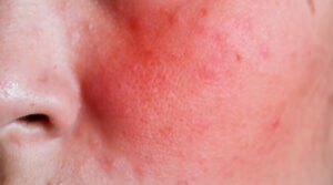 الديرمابن للندبات: يُشدّ البشرة ويُفتّح البقع في شهر