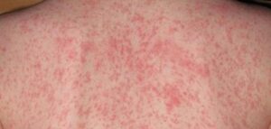 الطفح الجلدي المفاجئ يغطي وجهكِ أو جسمكِ فجأة؟ 8 أسباب تحسسية تُصيبك