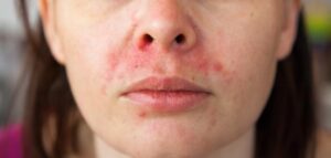 بشرة صافية في 14 يوم: نظام غذائي يطرد حب الشباب