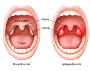 Treating tonsillitis with herbs and home remedies
