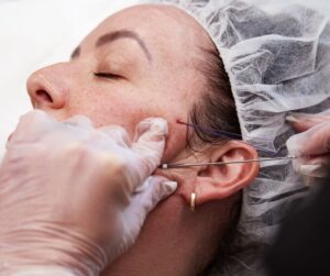 Thread lifting: The modern technique for taut skin