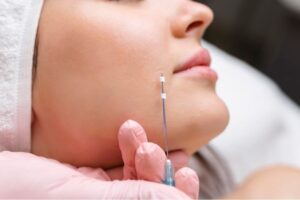 Thread lifting: The modern technique for taut skin